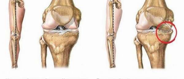 Варусная деформация коленных суставов лечение